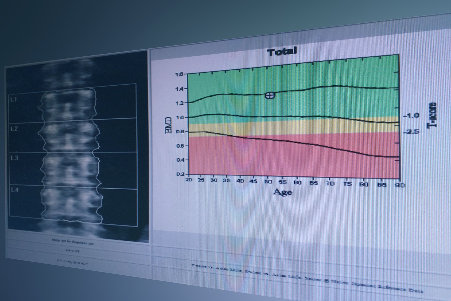 Soft and blurry image: special examination medical image lumbar spine bone density diagnosed no osteoporosis.