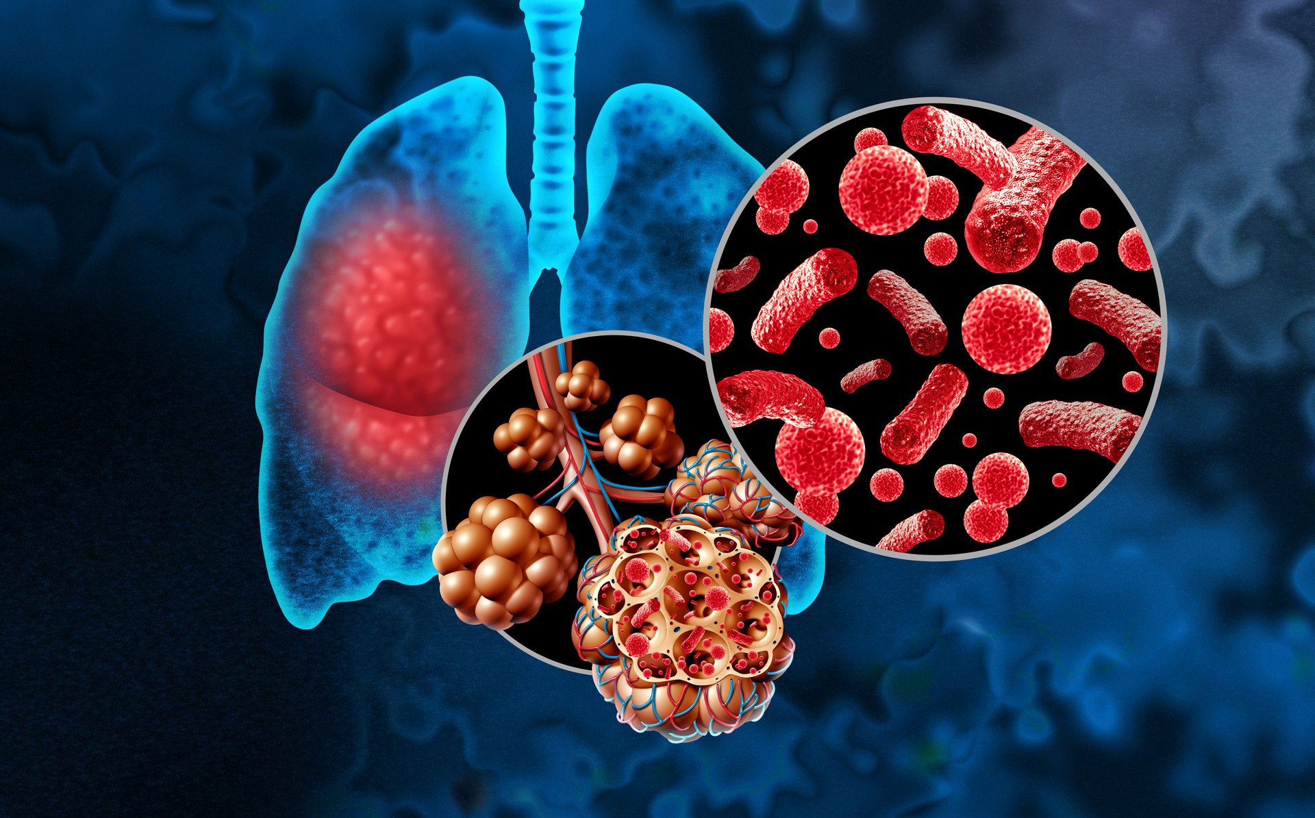Bacterial Pneumonia